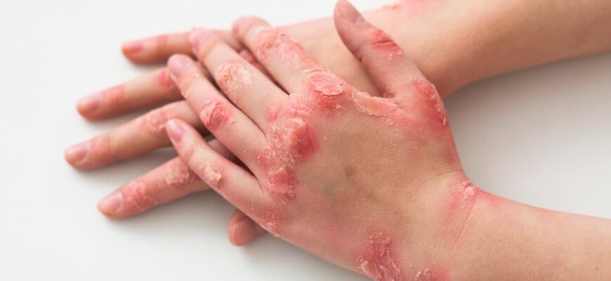 Ефективні засоби для лікування псоріазу на шкірі голови: огляд препаратів