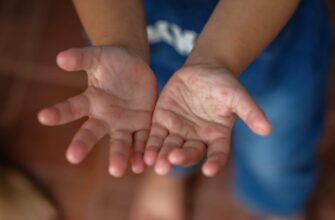 Ефективні засоби для лікування висипів при вірусі Коксакі: чим мазати?