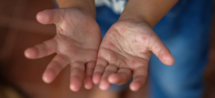 Ефективні засоби для лікування висипів при вірусі Коксакі: чим мазати?