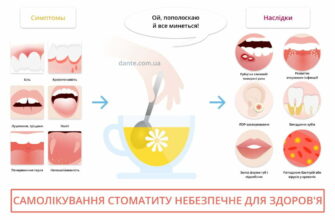 Ефективні засоби для швидкого лікування стоматиту в домашніх умовах