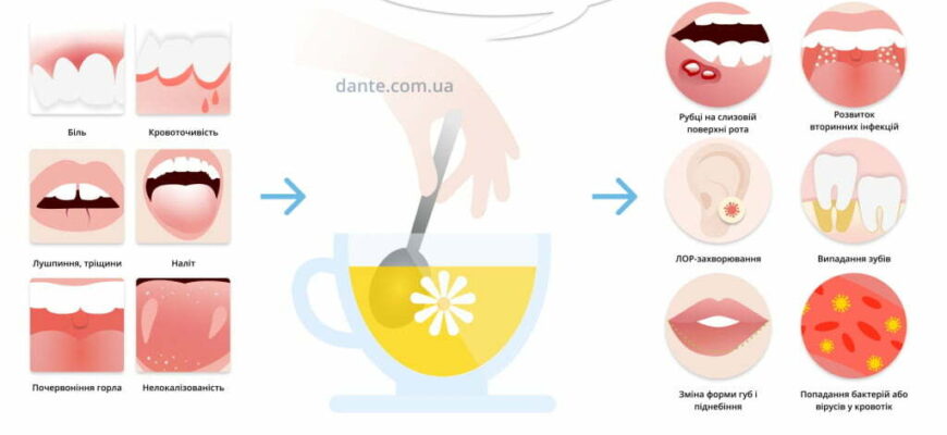 Ефективні засоби для швидкого лікування стоматиту в домашніх умовах
