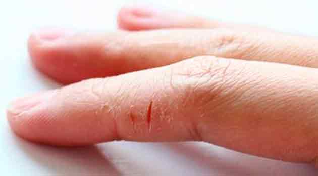 Лікування тріщин на п'ятах в Києві: методи, ціни