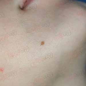 Папіломи - видалення (лікування) папілом у Києві - ціна та відгуки ...