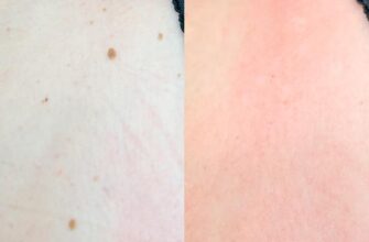 Ефективний догляд за раною після видалення папіломи: поради та рекомендації