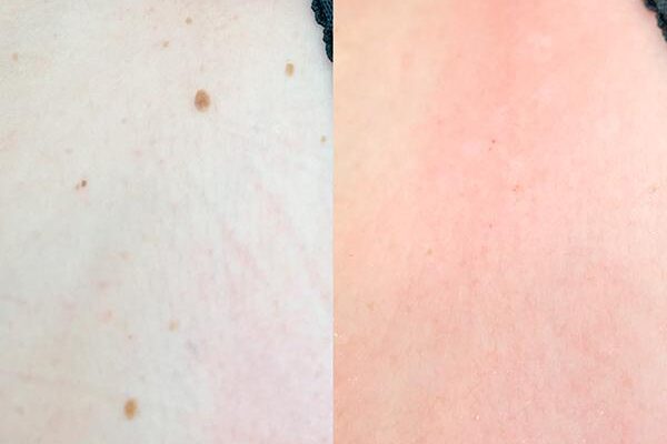 Ефективний догляд за раною після видалення папіломи: поради та рекомендації