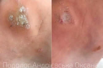 Ефективний догляд за шкірою після видалення бородавки рідким азотом