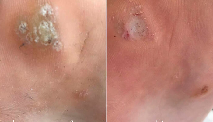 Ефективний догляд за шкірою після видалення бородавки рідким азотом