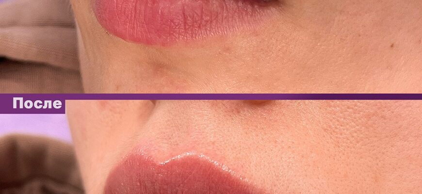 Етапи загоєння губ після збільшення: детальний опис по днях