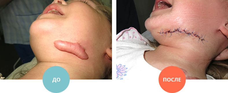 Лікування келоїдних рубців