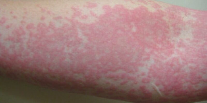 Фото симптомів алергії на ліки: визначення та ефективне лікування