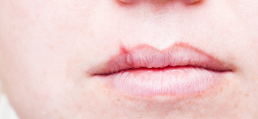 Герпес після збільшення губ: причини, симптоми та лікування