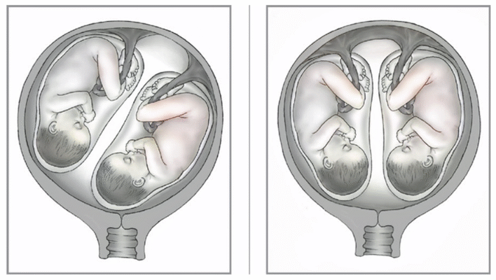 Головний біль при вагітності: що можна приймати без шкоди мамі і малюку