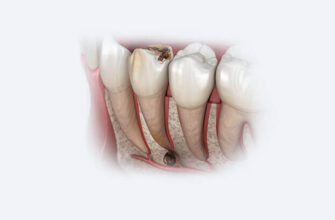 Гострий зубний біль: причини, лікування та ефективні засоби полегшення