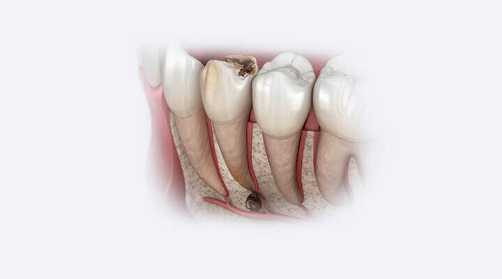 Гострий зубний біль: причини, лікування та ефективні засоби полегшення