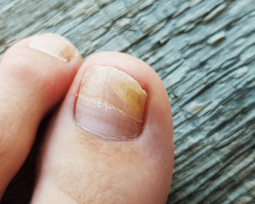 Грибок нігтів після гель-лаку: причини, симптоми, лікування та профілактика