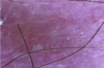 Імунобіологічні ліки від псоріазу: сучасні методи лікування та переваги