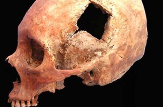 Інвалідність після трепанації черепа: причини, наслідки та підтримка