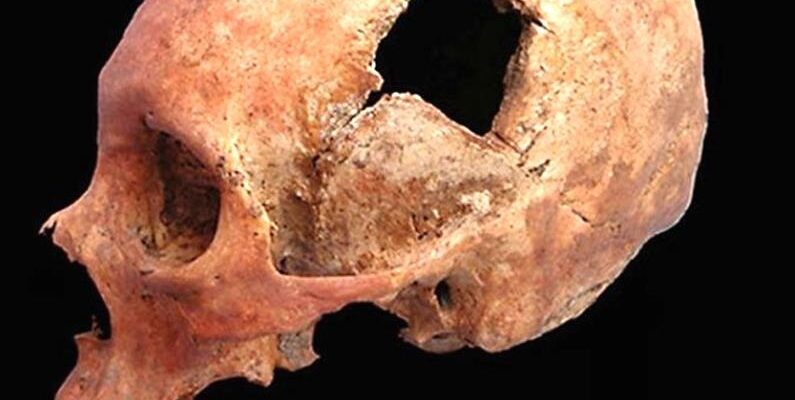 Інвалідність після трепанації черепа: причини, наслідки та підтримка