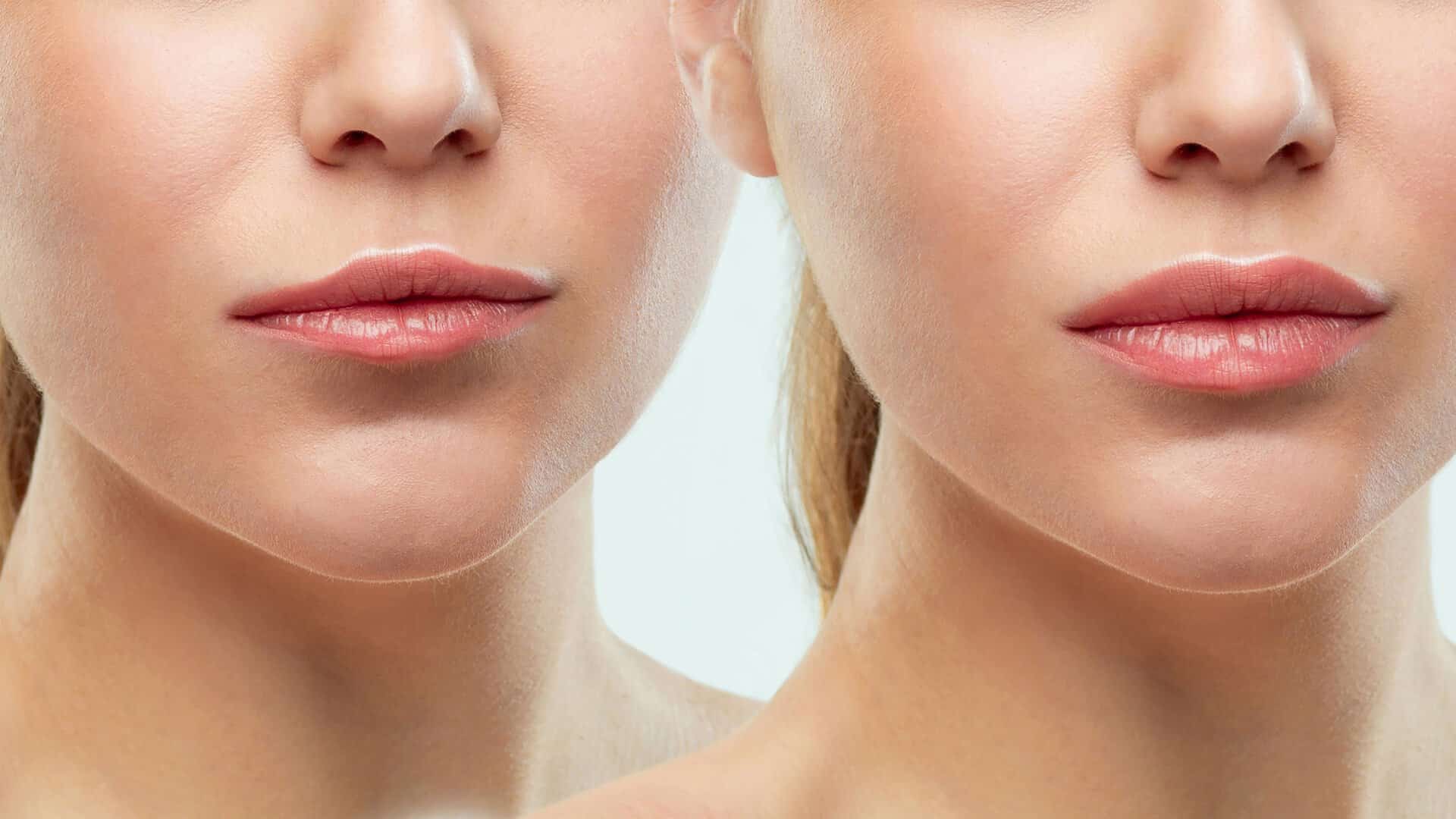 Інфекція губ, викликана філерами: симптоми, лікування та втручання ...