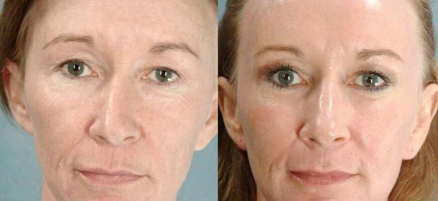 Карбоновий пілінг: скільки потрібно процедур для оптимального ефекту?