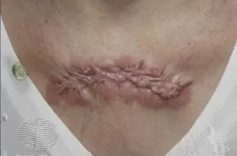 Келоїдний рубець після видалення родимки: причини та лікування