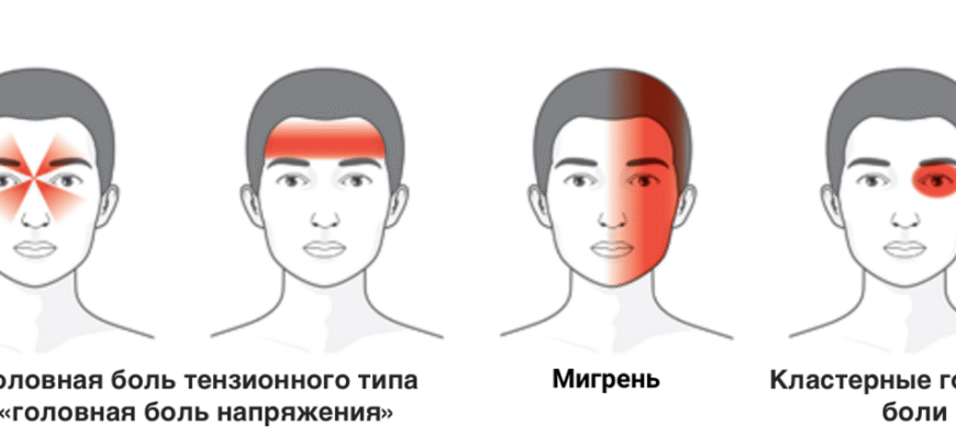 Хронічний головний біль напруги: симптоми і методи впізнання