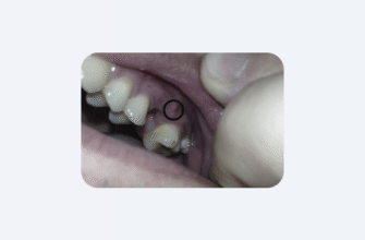 Коли дозволено їсти після видалення зуба: поради та рекомендації