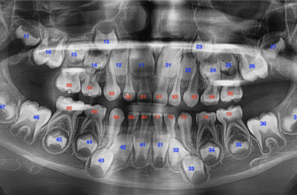 Коли і чому варто видаляти зуби мудрості: поради стоматологів