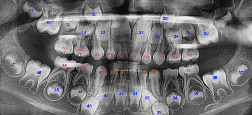 Коли і чому варто видаляти зуби мудрості: поради стоматологів