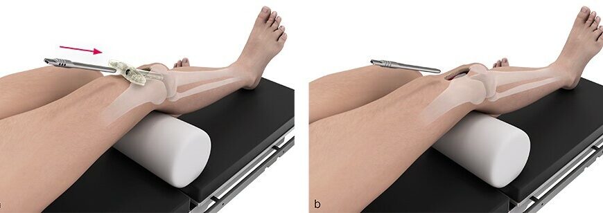 Коли можна навантажувати ногу після остеосинтезу: поради лікарів