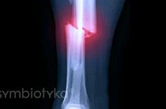 Коли можна почати ходити після перелому гомілки: рекомендації лікарів