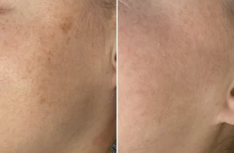 Коли настає полегшення після лікування п’явками: терміни та ефект