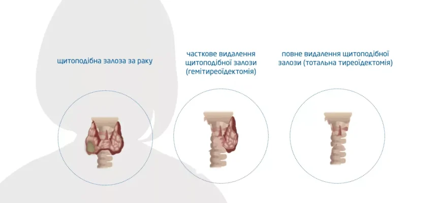 Коли варто видалити вузол на щитовидній залозі: основні покази та рішення