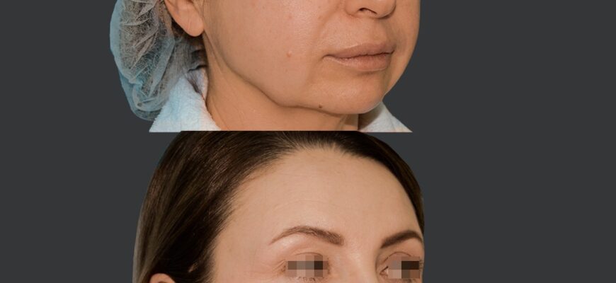 Коли зникає птоз після ботоксу: терміни відновлення та поради