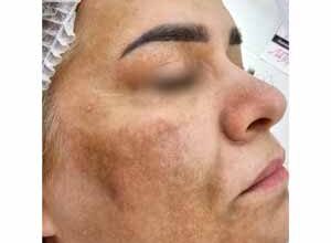 Коричневі виділення після постинору: причини і коли хвилюватися