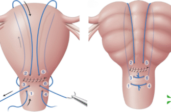 Кровотеча після видалення спіралі: причини, симптоми та дії