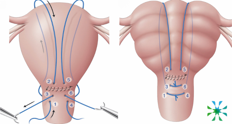 Кровотеча після видалення спіралі: причини, симптоми та дії