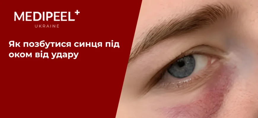 Крововилив в око після удару: причини, симптоми та лікування