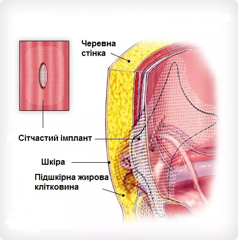 Грижа | ЗОКЛ