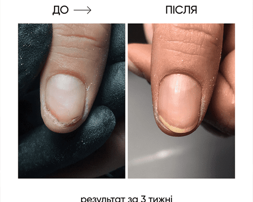 Лікування оніхолізису після гель-лаку: ефективні методи й поради
