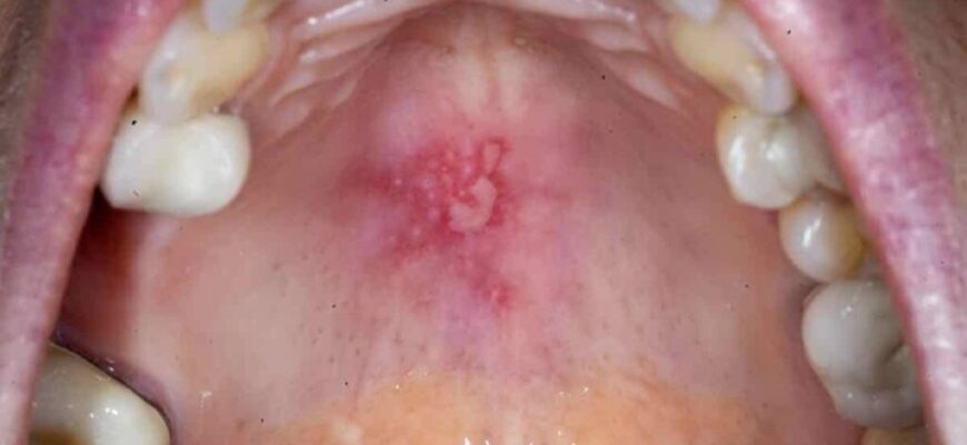 Лікування рани на піднебінні: ефективні методи і поради лікарів Лікування рани на піднебінні: ефективні методи і поради лікарів