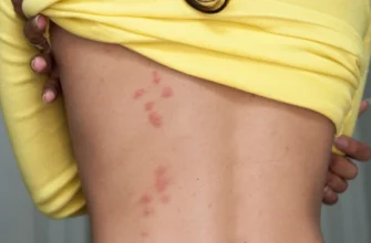 Лікування сверблячого висипу на шкірі: ефективні методи та поради
