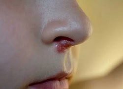 Лікування вавок в носі: ефективні методи та рекомендації фахівців