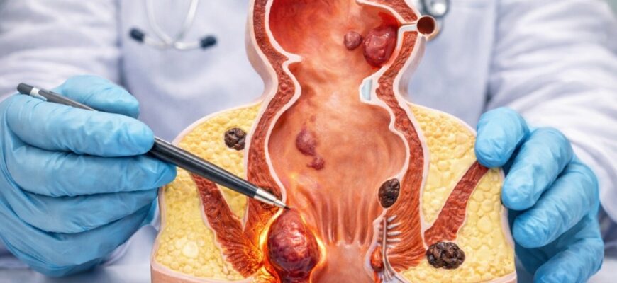 Лікування зовнішнього геморою після пологів: ефективні методи та поради