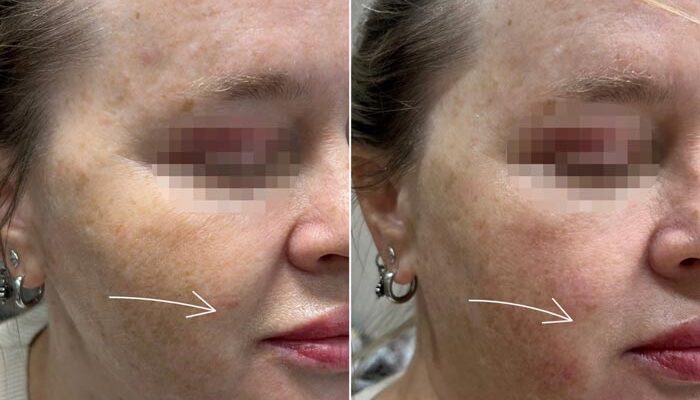 Ліполітики для підборіддя: ефект до і після – реальні результати