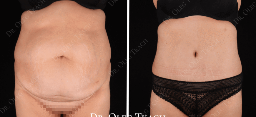 Ліпосакція: результати до і після процедури – відгуки та поради