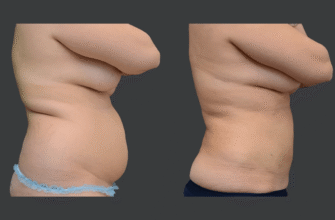 Ліпосакція живота: результати до і після процедури – що очікувати?