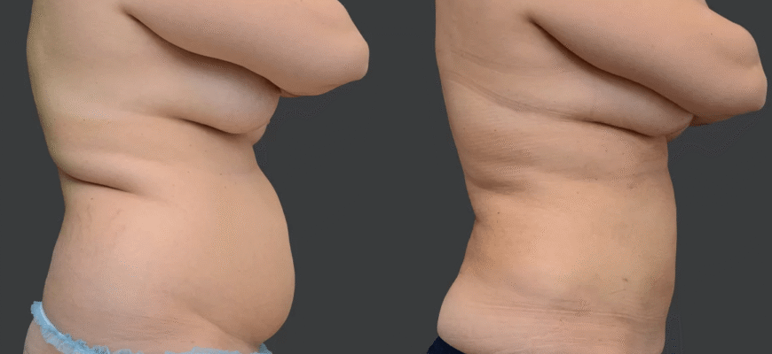 Ліпосакція живота: результати до і після процедури – що очікувати?