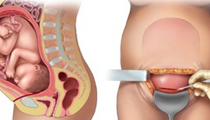 Лохії після кесаревого розтину: що очікувати та як доглядати за собою