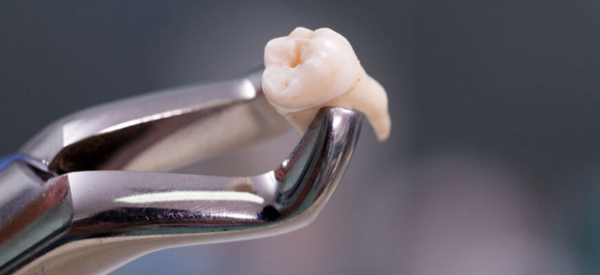 Лунка після видалення зуба: як доглядати та уникнути ускладнень